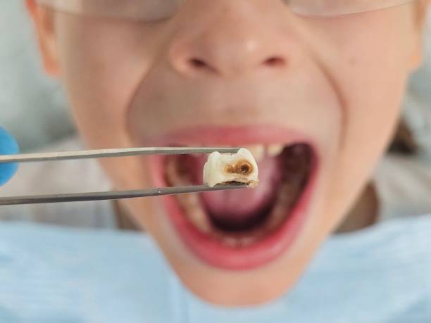 Best Emergency Wisdom Tooth Extraction in Hampton, GA